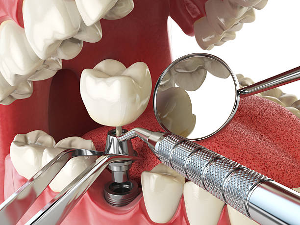 Best Emergency Cosmetic Dentistry (e.g., broken veneers) in Central Square, NY